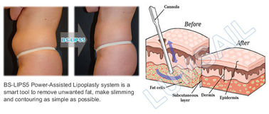 معدات شفط الدهون بالليزر بمساعدة الجسم لتمليس الجسم